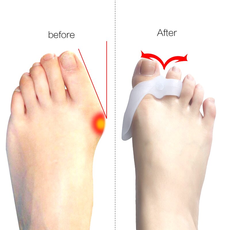 Soft Gel Bunion Corrector Hallux Valgus Stretcher Thumb Bone Adjuster